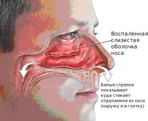 Воспаление слизистой носа